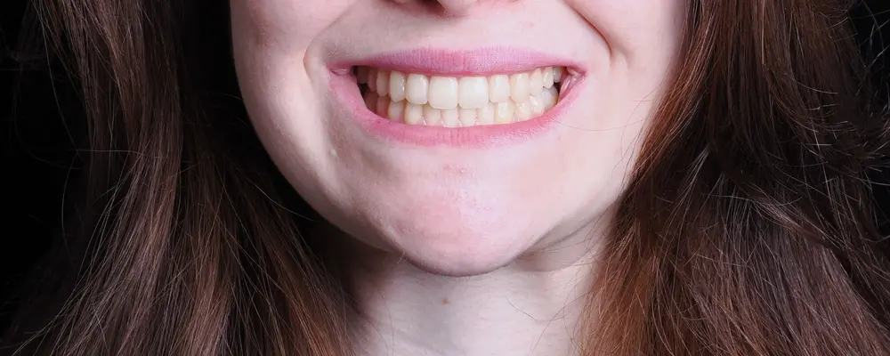 Cas 02, le sourire obtenu après traitement