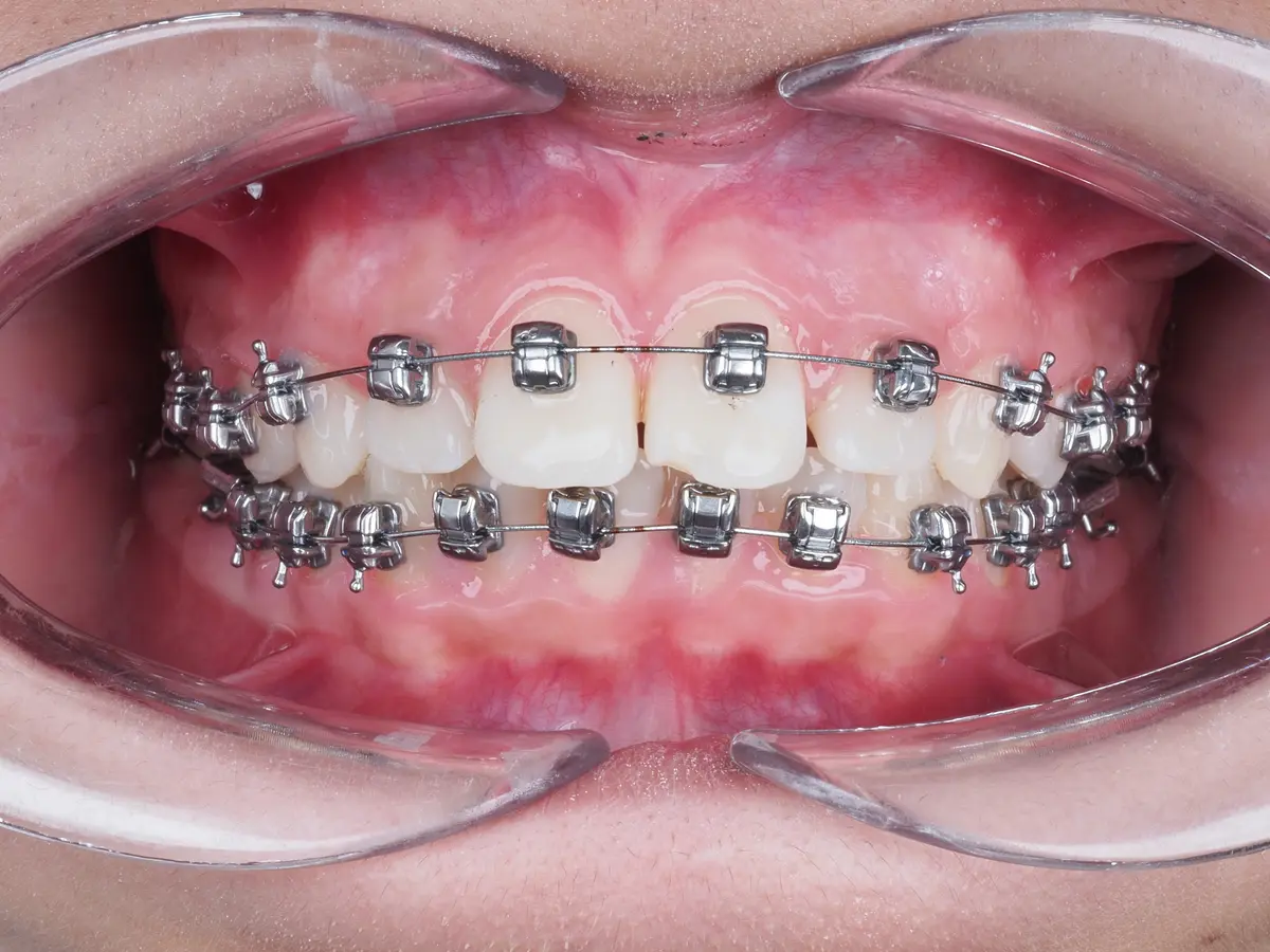 Traitement d'orthodontie adulte par bagues, vue intra-orale